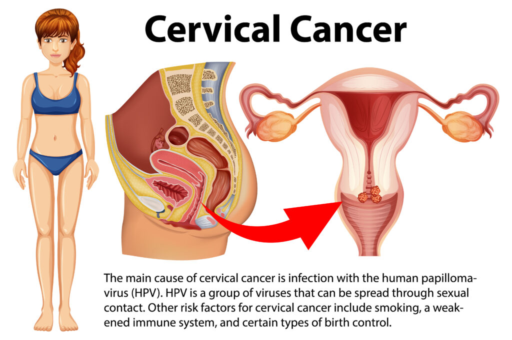 cervical cancer infographic with explanation